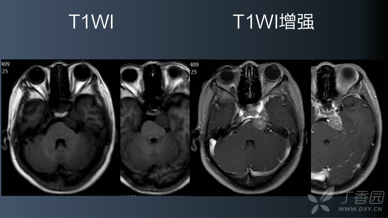 【医学影像病例精析】031左侧桥前池海绵窦实性占位mri诊断[病例帖]