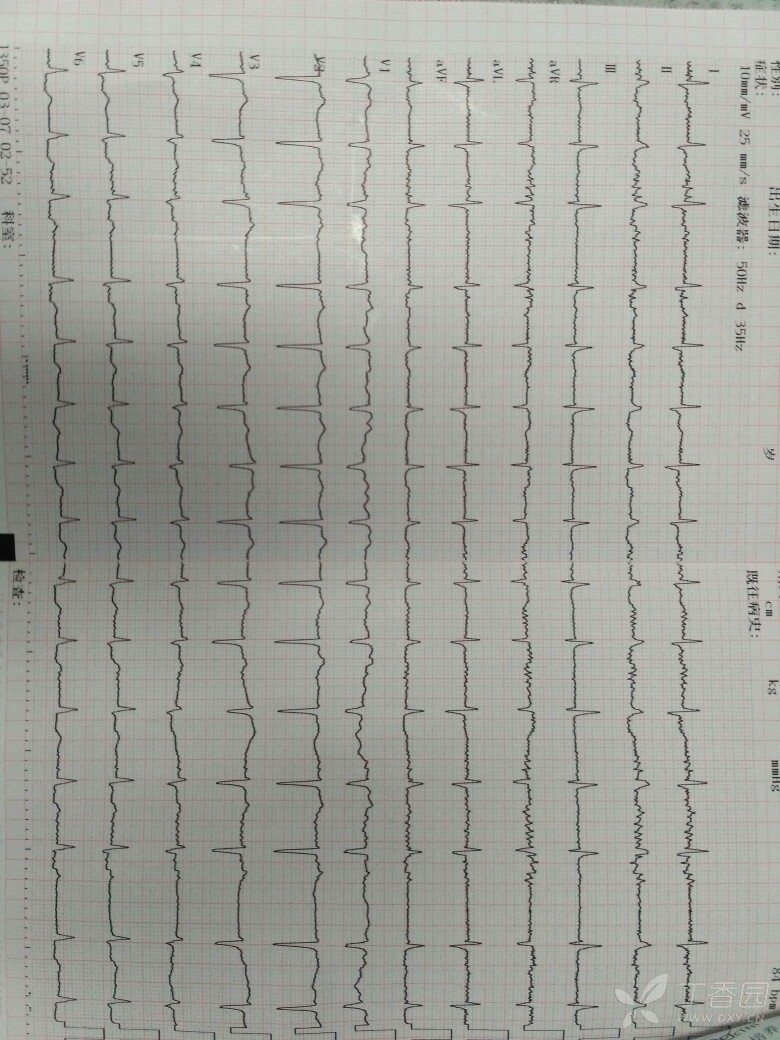 心电图请教 报的是房速 看起来像房颤啊,求解答~ 2018-01-05 21:04