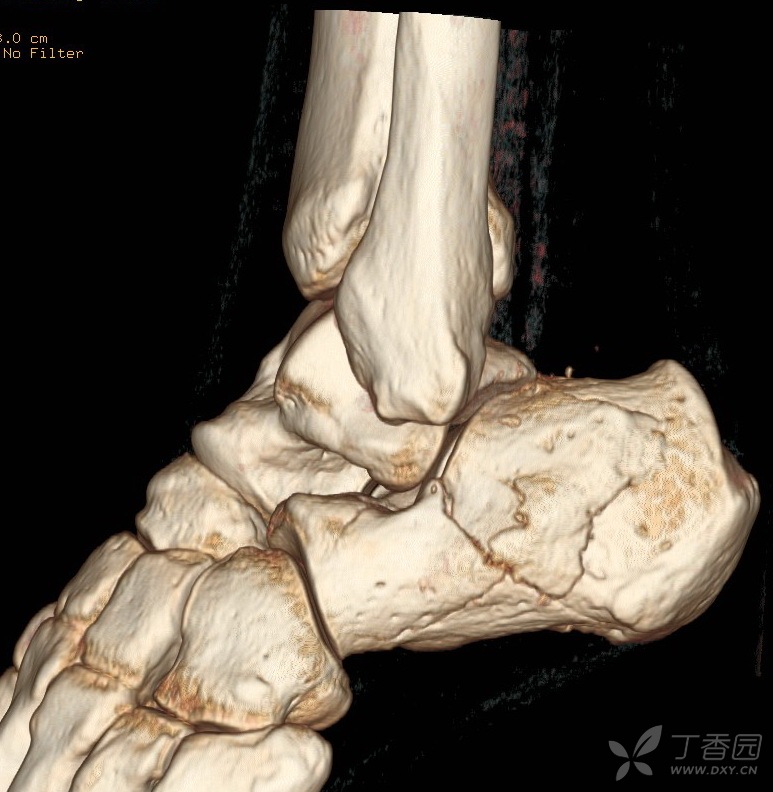 跟骨骨折如何保守治疗 [病例帖]