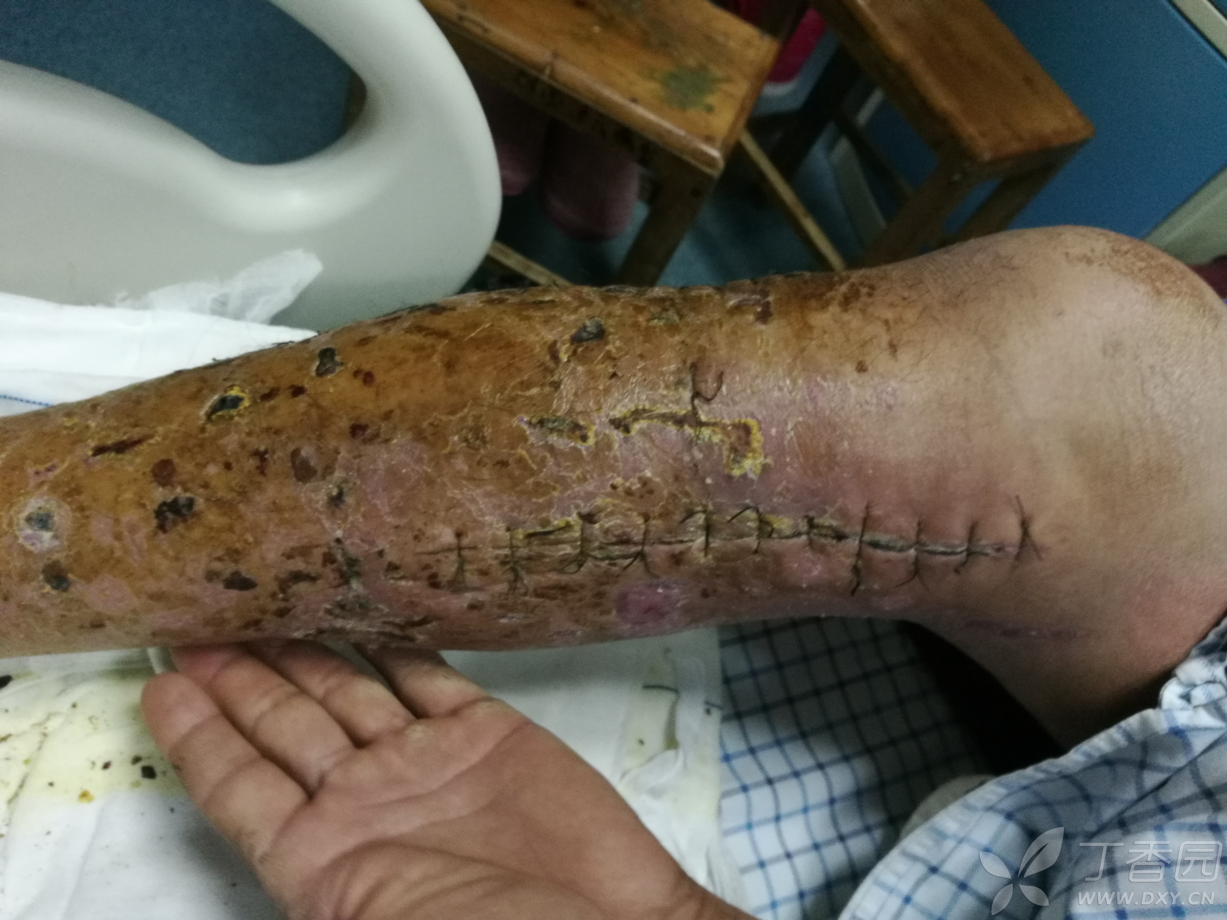 昨天,也就是术后13天皮肤情况,无感染和坏死