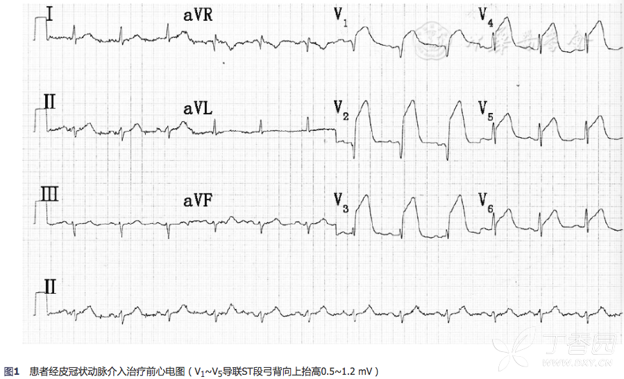 每周病例分析:以头痛为唯一症状的急性心肌梗死