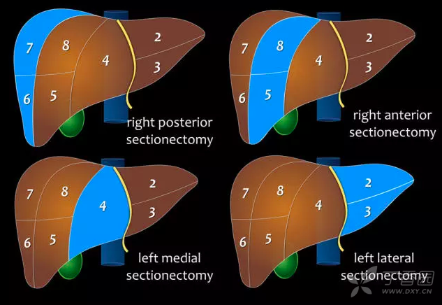 左内叶,左外叶肝切除术 总结 对于肝脏的分叶,主要记住三个叶间裂(肝