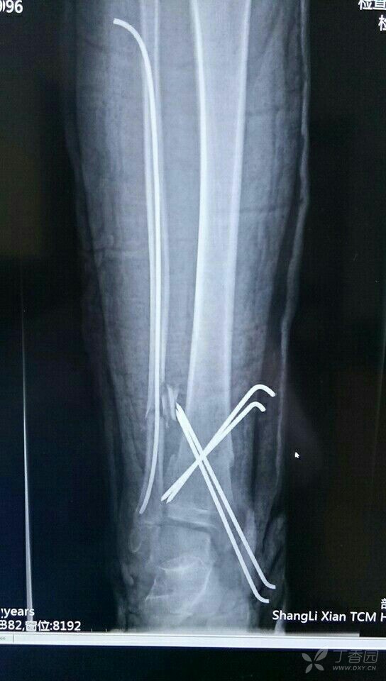 14岁胫腓骨下段骨折,求手术方案. [病例帖]