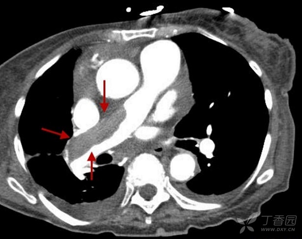 从入门到精通:ct 能看出的 10 种「肺动脉病变」