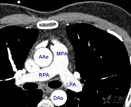 从入门到精通:ct 能看出的 10 种「肺动脉病变」