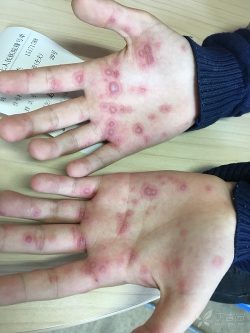 今天见到一个病人,口腔疱疹,手足疱疹,疱疹周围有环形红斑