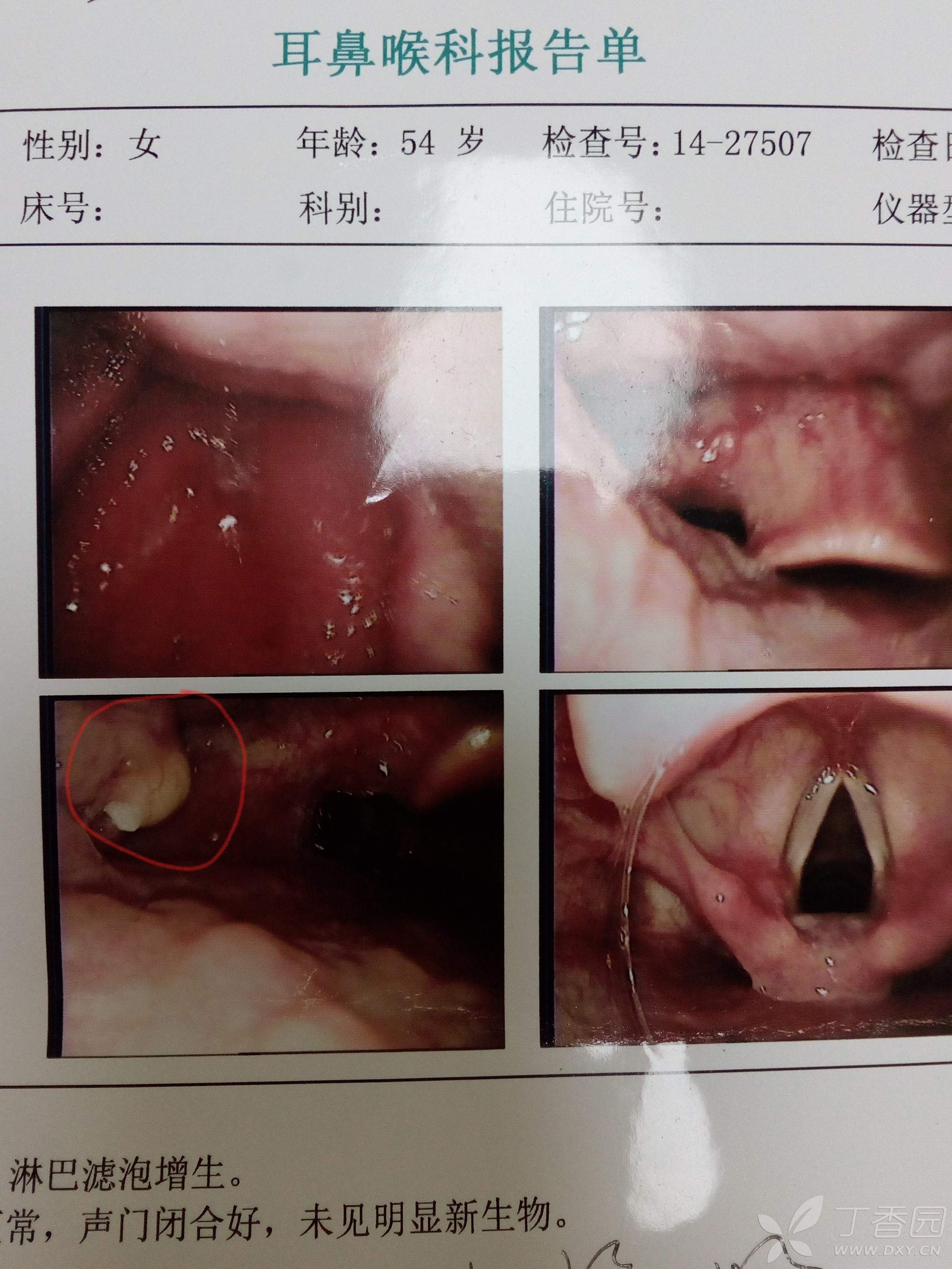 求助:咽部异物,偶有白色米粒状分泌物,附喉镜检查结果
