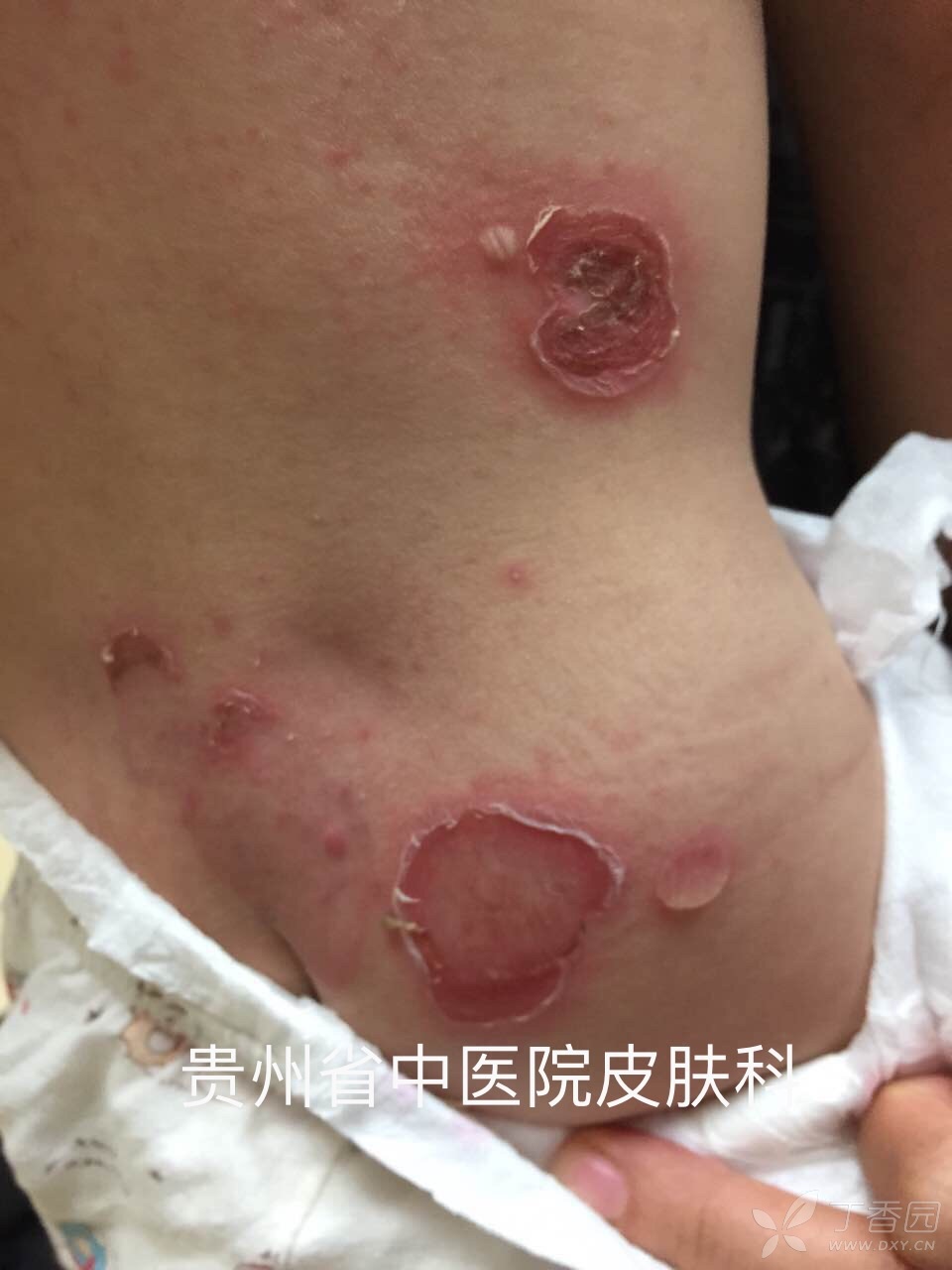 是脓疱病?传染性湿疹样皮炎?