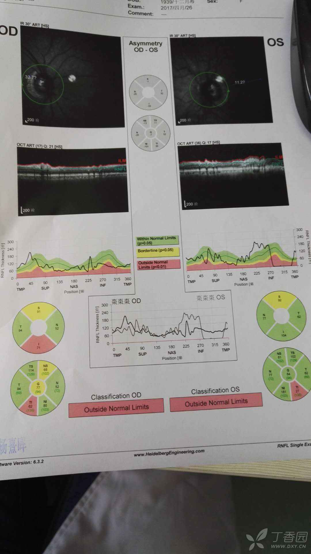 请帮忙解读一下视神经纤维oct - 眼科专业讨论版