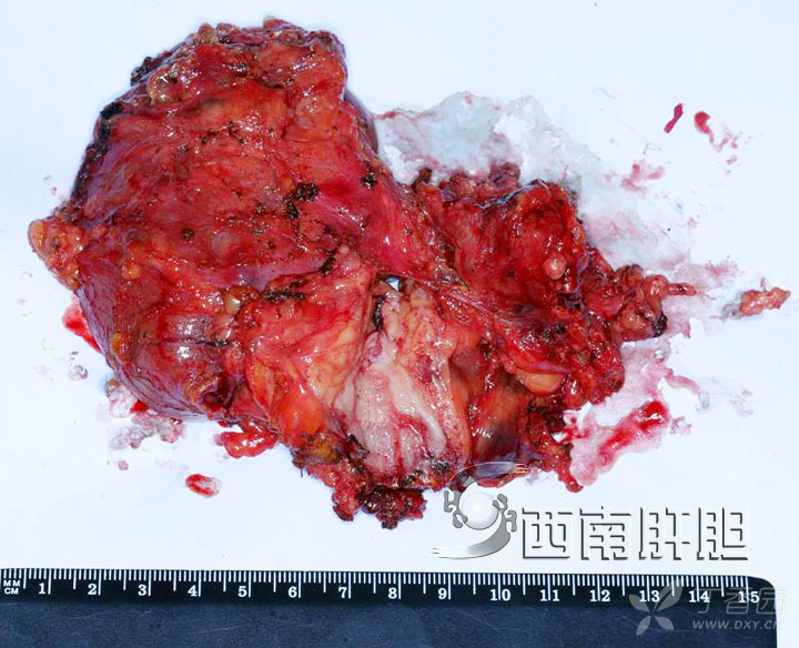 查看 可能涉及到敏感图片,点击后可查看 术后病理(胆总管)中分化腺癌