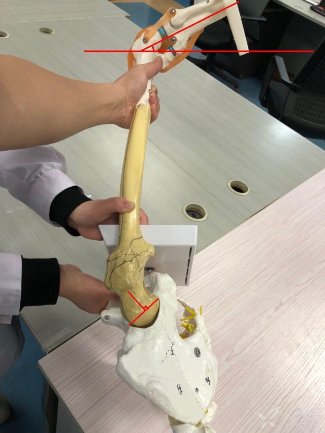 骨科专业讨论版 帖子详情  传上一张测量联合前倾角的照片