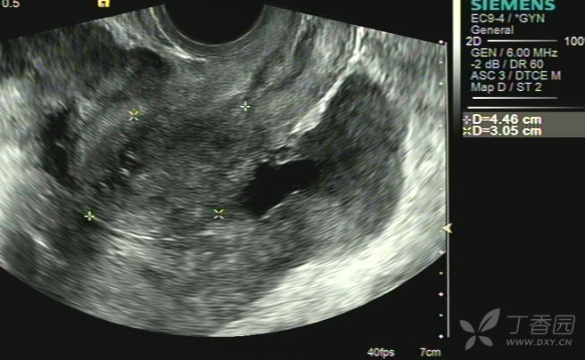 输卵管癌2 超声医学讨论版-丁香园论坛