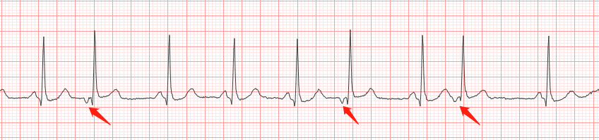 2 房室交界性早搏 p`波形与正常窦 p 不同,p-r 间期0.12s.