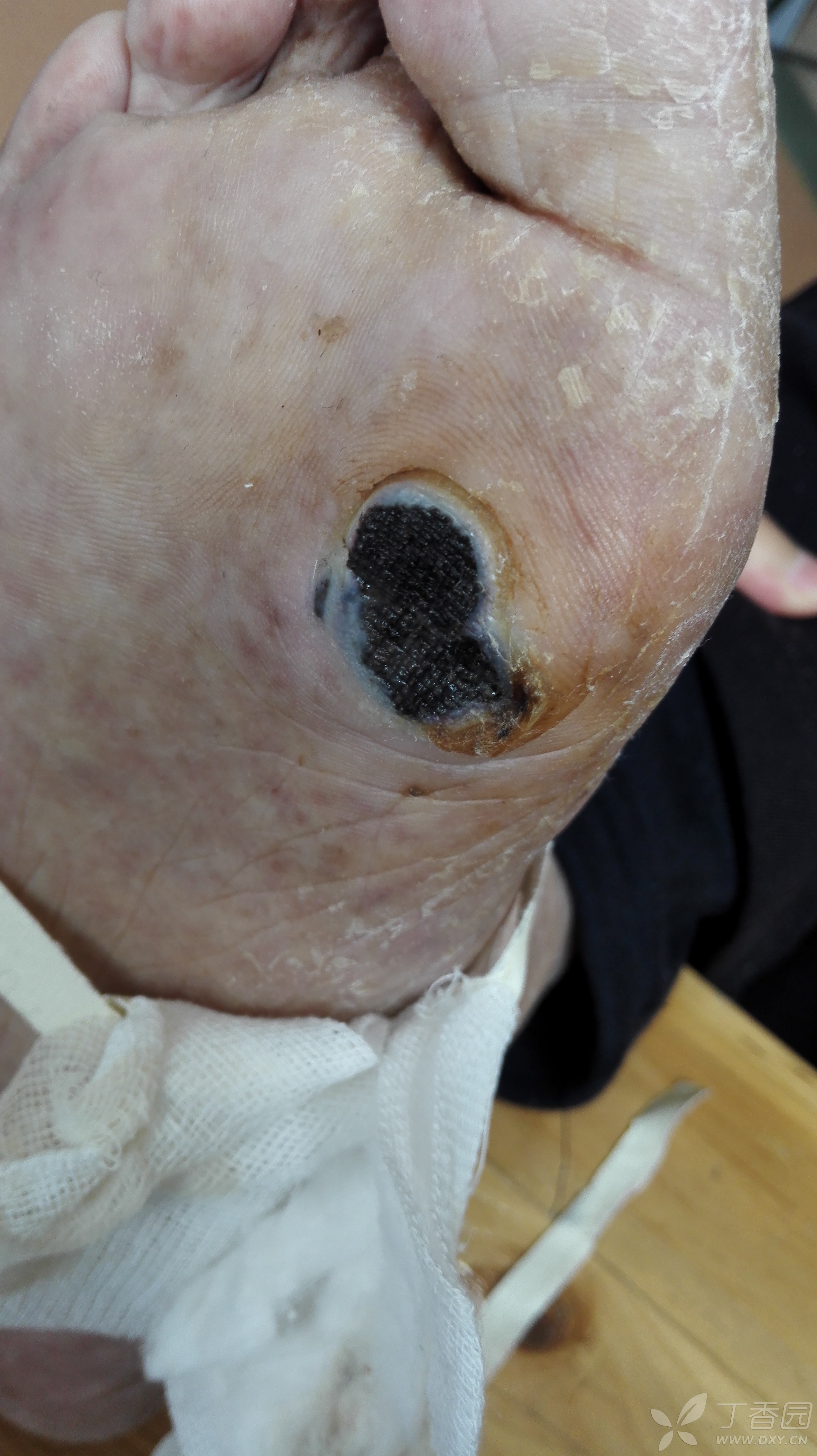 典型病例:恶性黑色素瘤.男85岁,右足色素性溃疡伴疼痛