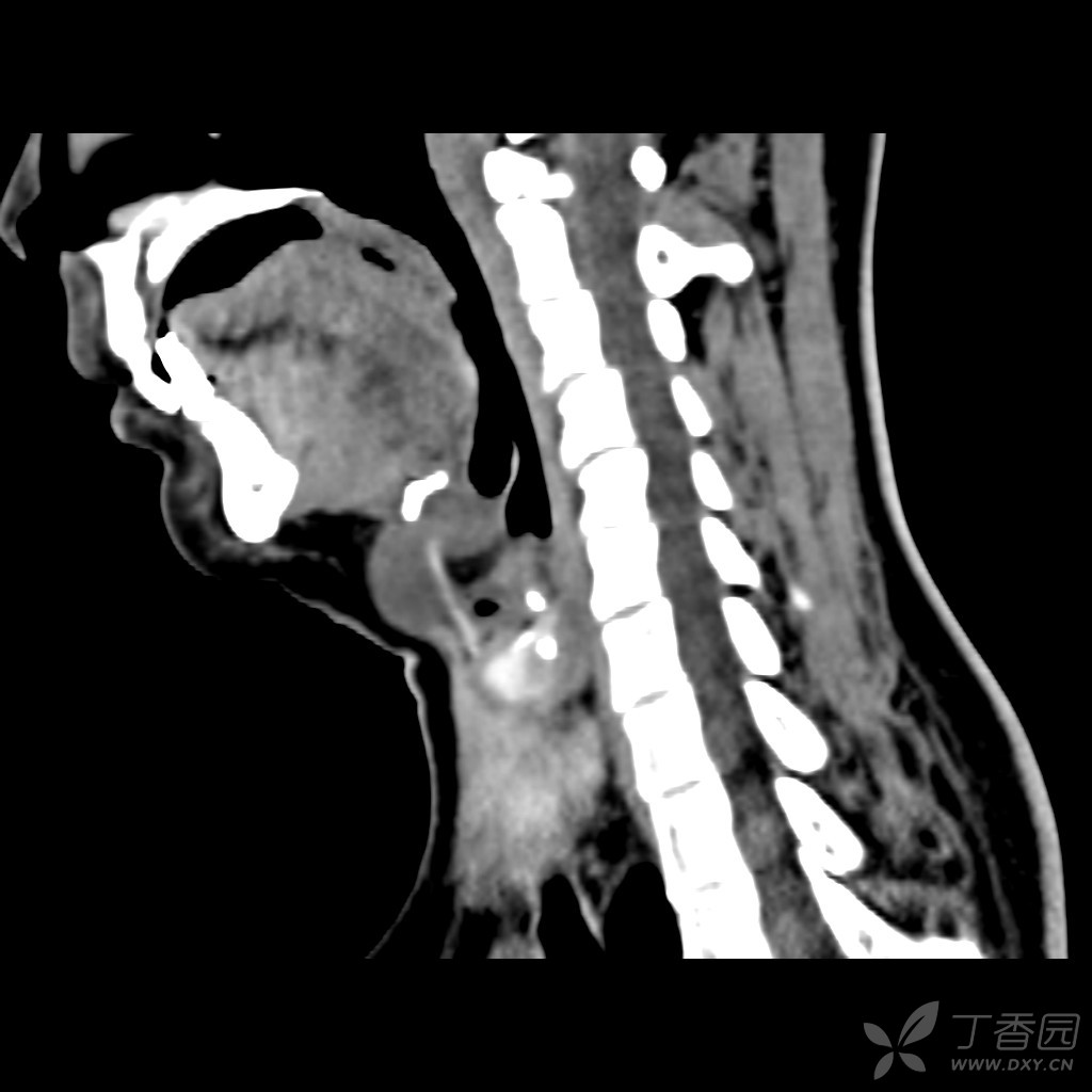 典型甲状舌管囊肿