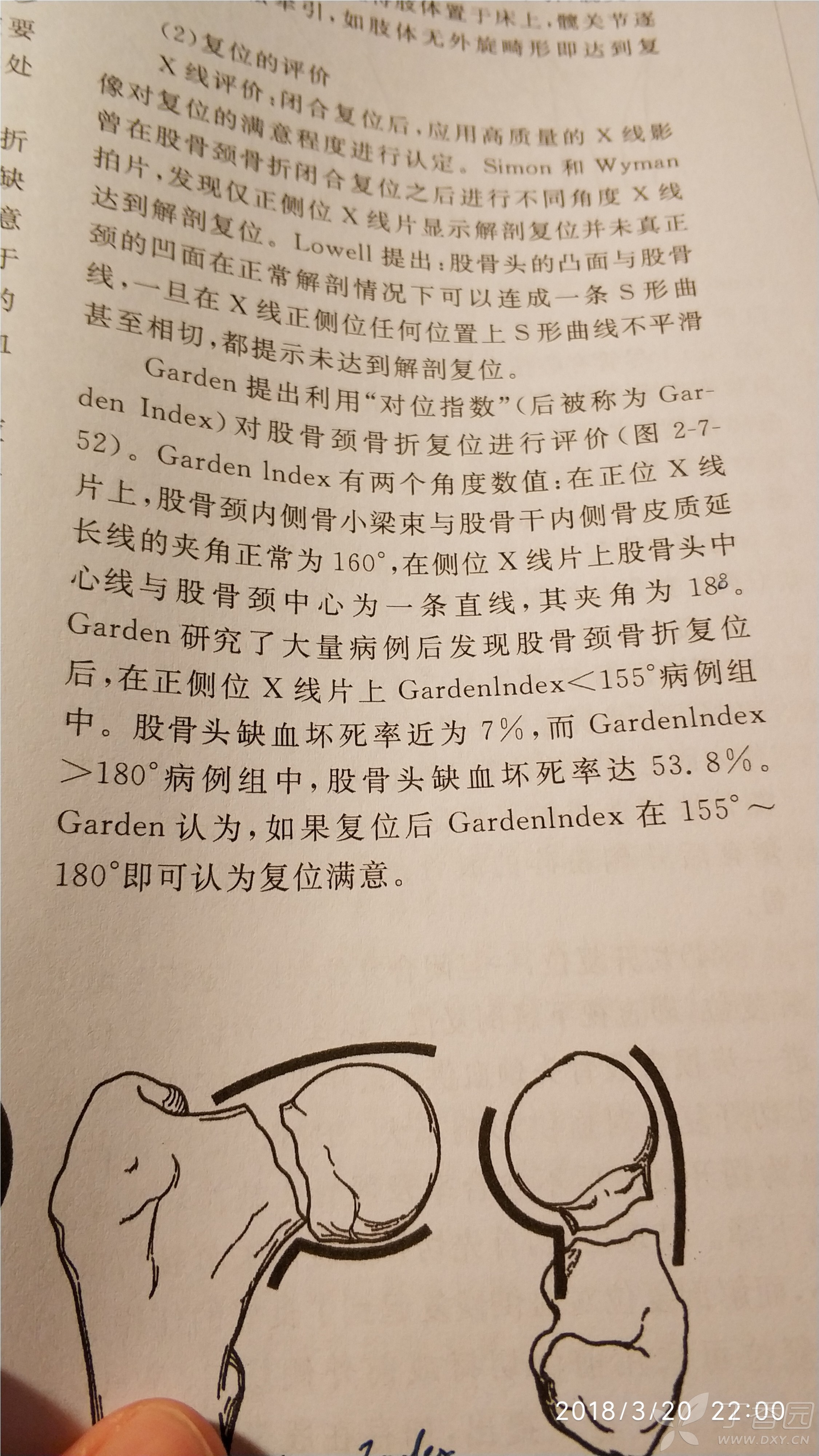 请教关于 股骨颈骨折复位评价标准 garden index 三级,四级复位标准中