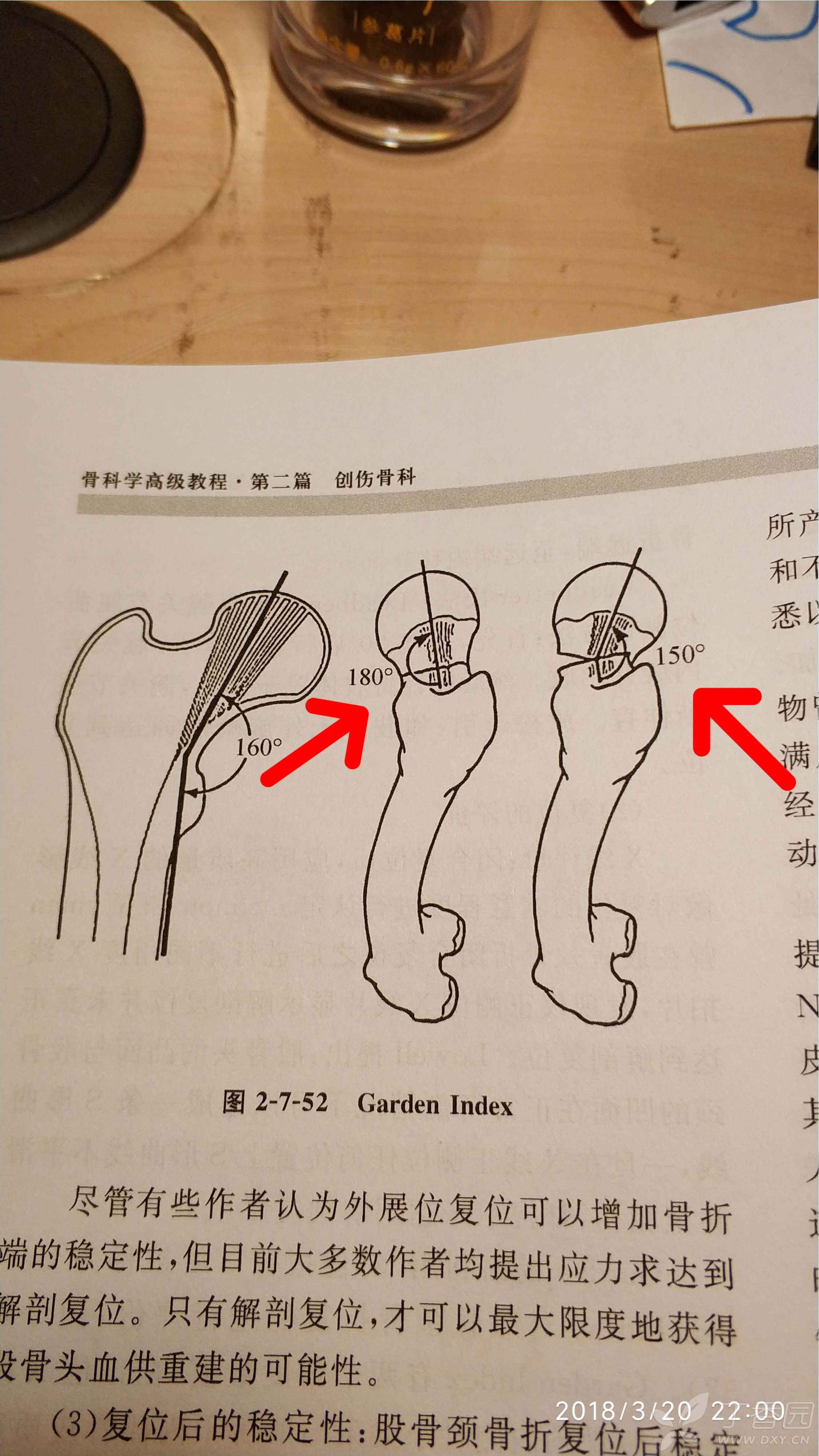 请教关于 股骨颈骨折复位评价标准 garden index 三级