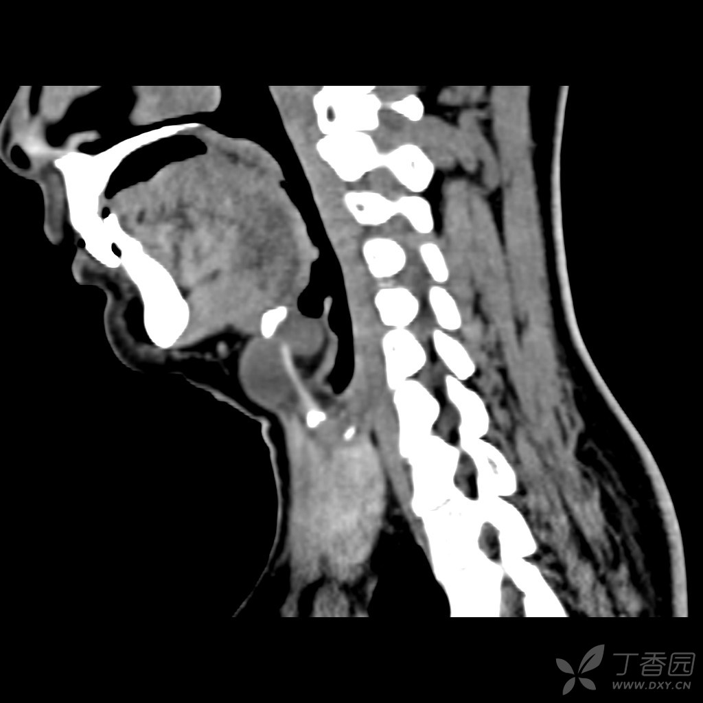 典型甲状舌管囊肿