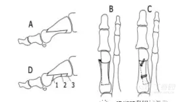 对当前拇外翻常用术式的术评 - 骨科专业讨论版