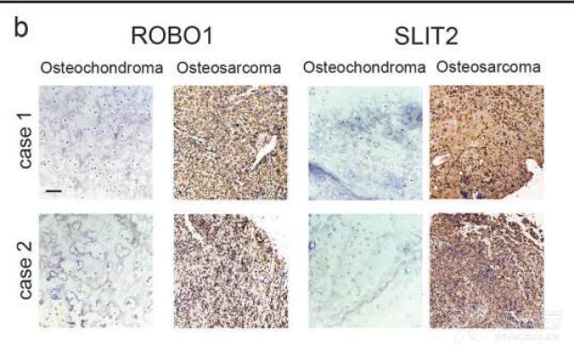 为什么骨肉瘤的免疫组化对照组用的是软骨肉瘤?