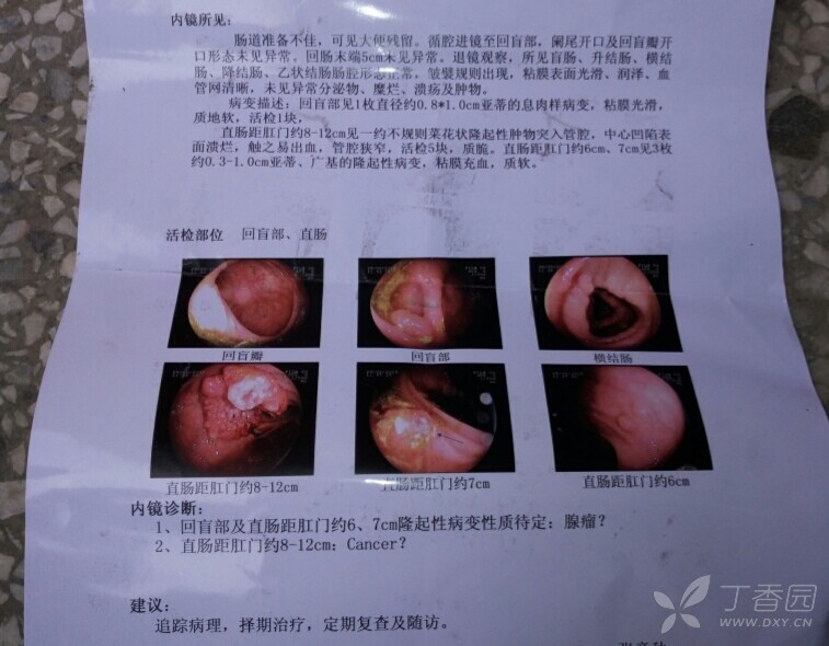 直肠腺癌?