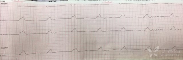 患者呼吸停止 无大动脉搏动,抢救30分钟后宣布死亡,到现场心电图如下