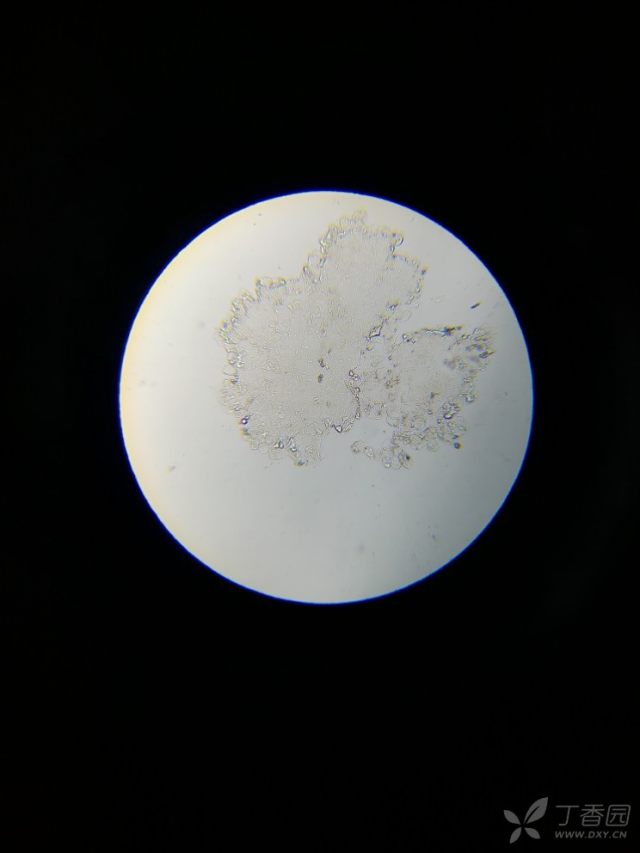 显微镜观察皮屑里有没有真菌 - 皮肤与性传播疾病讨论
