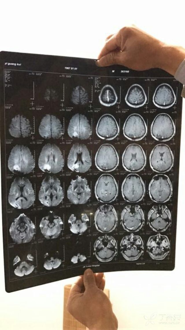 请教脑肿瘤手术复发治疗方案