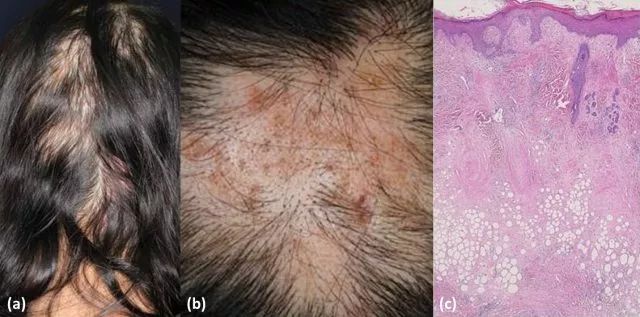 查体可见头皮多发脱发斑及轻度凹陷性改变(图 1a,b). 图 1 a.