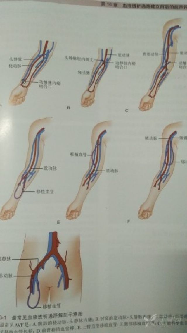 比较常见的是上肢自体avf,这其中又以腕部的桡动脉-头静脉内瘘最为