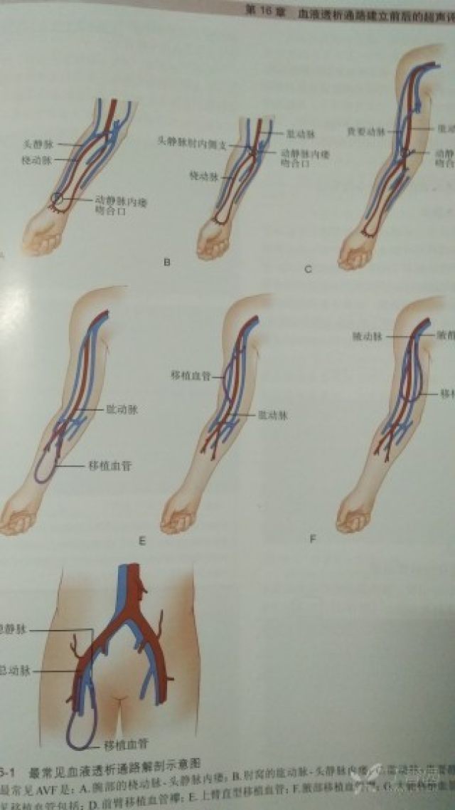 血液透析通路一般有avf,移植血管和中心静脉导管等,比较常见的是上肢