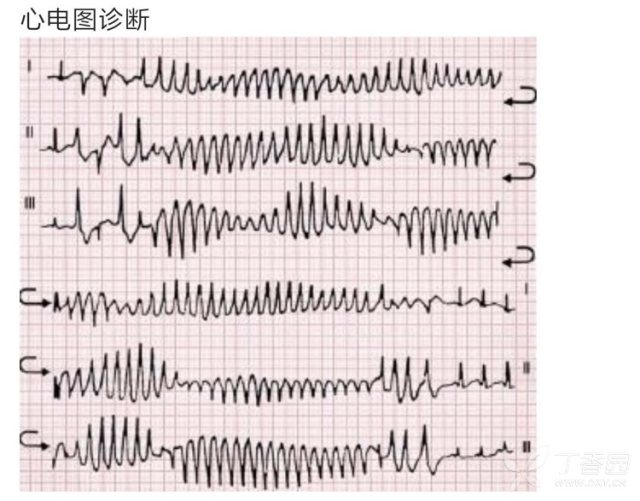 相关疾病: 室性心动过速 麻烦大家帮忙看一下这两张心电图,是尖端扭转