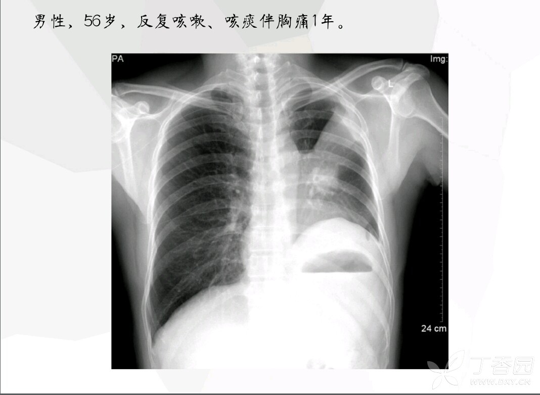 希望有老师能给我解释一下,他的左肺下部那个气液平面是啥?