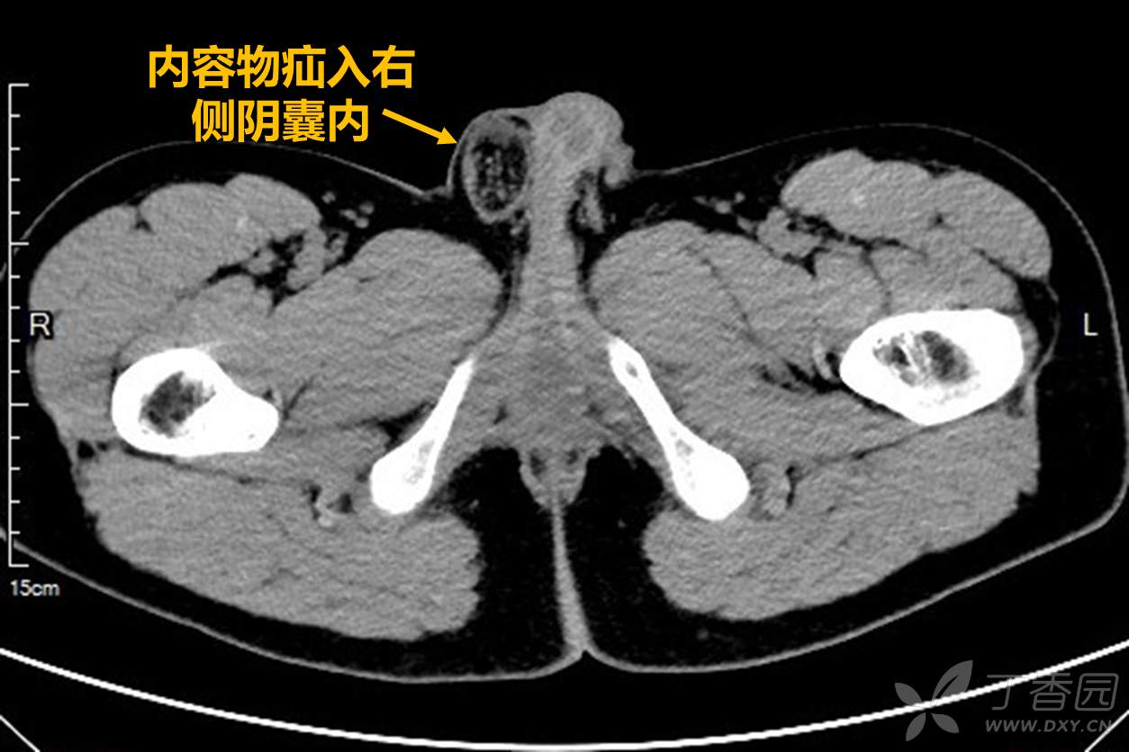 讨论版 浅表器官 帖子详情 根据疝内容物回声可初步判断应为网膜疝