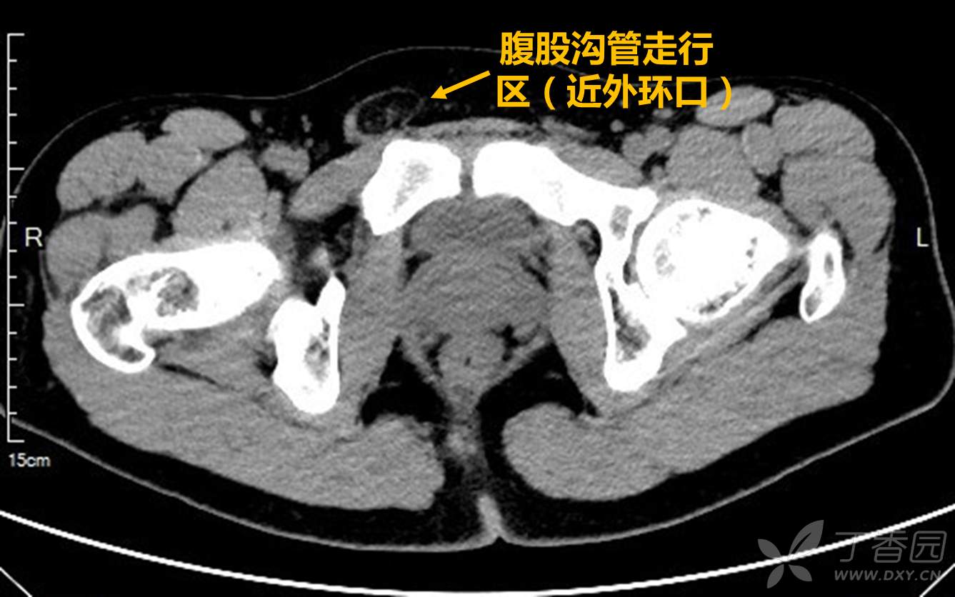 分享一例右侧腹股沟斜疝