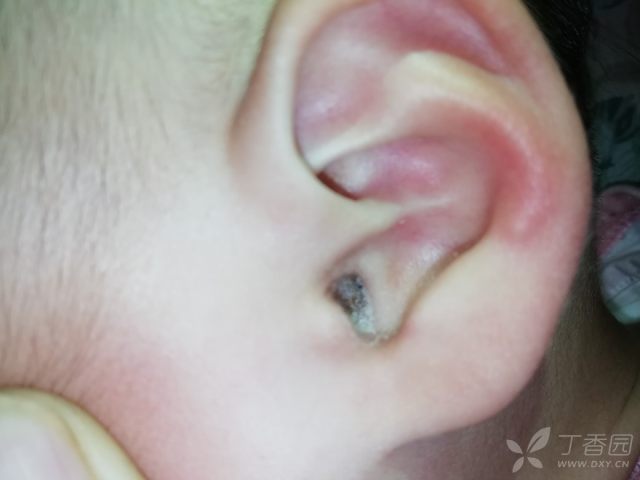 耳鼻咽喉头颈外科专业讨论版  一岁女宝宝,耳朵瘙痒半年,经常搔抓.
