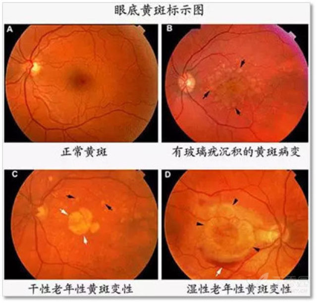 研究者眼底黄斑示意图