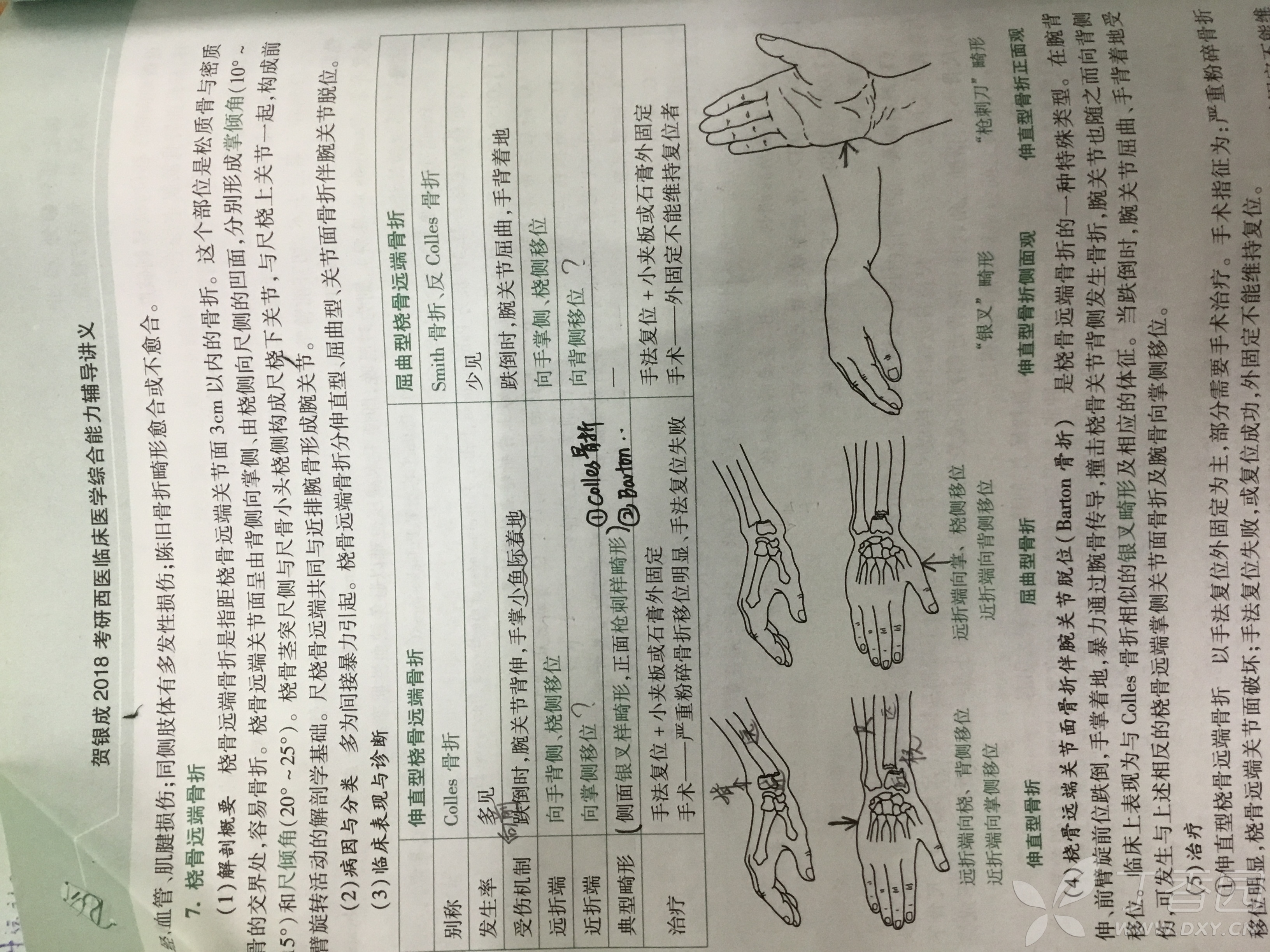 colles与smith骨折区别