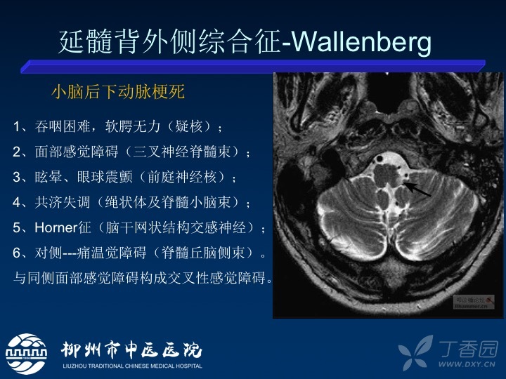 总结:延髓经典综合征和少见综合征(图文详解)