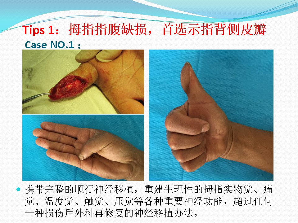 刘应良:手指创面皮瓣修复的六项原则&推荐建议