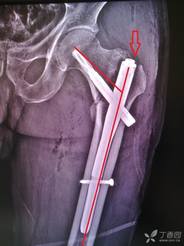 考虑是扩髓不充分;2,髋内翻了,虽然比上一例好一些,谈不上阳性支撑