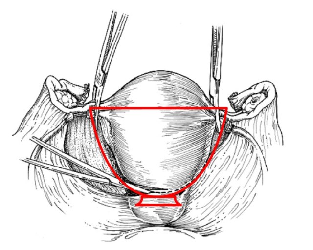 碗与子宫的解剖