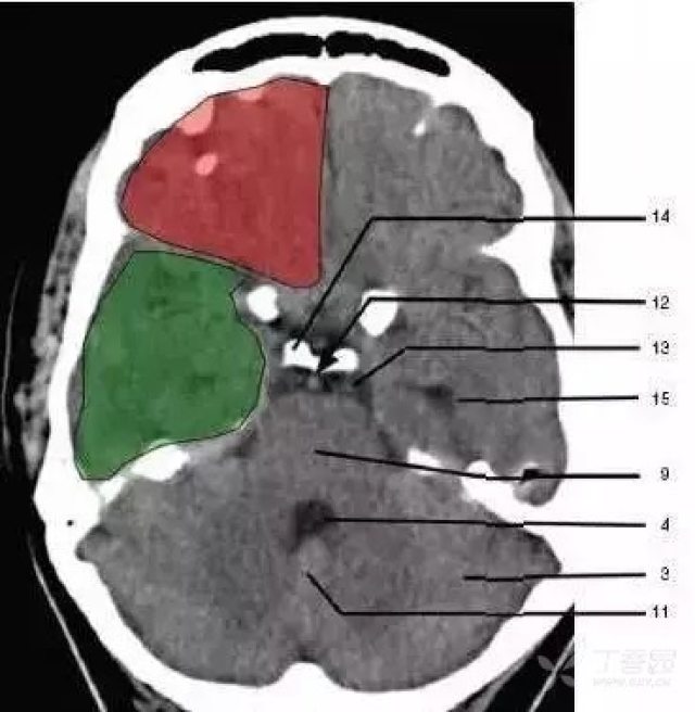 影像医学和核医学讨论版 资源  11,小脑蚓部(cerebellar vermis) 12