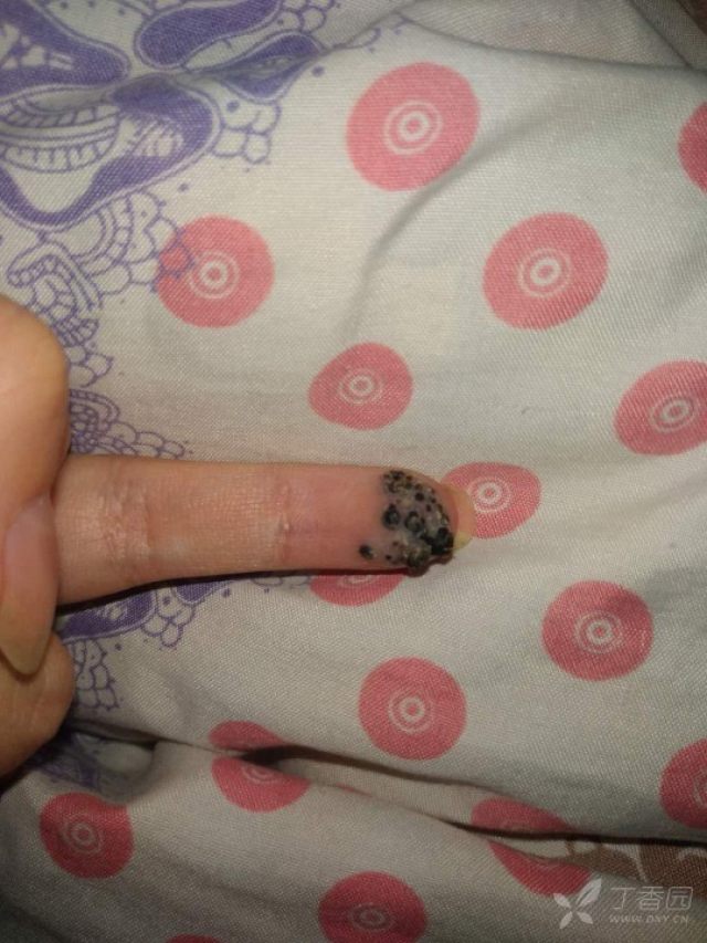 手指上长了黑色的疣 - 皮肤与性传播疾病讨论版