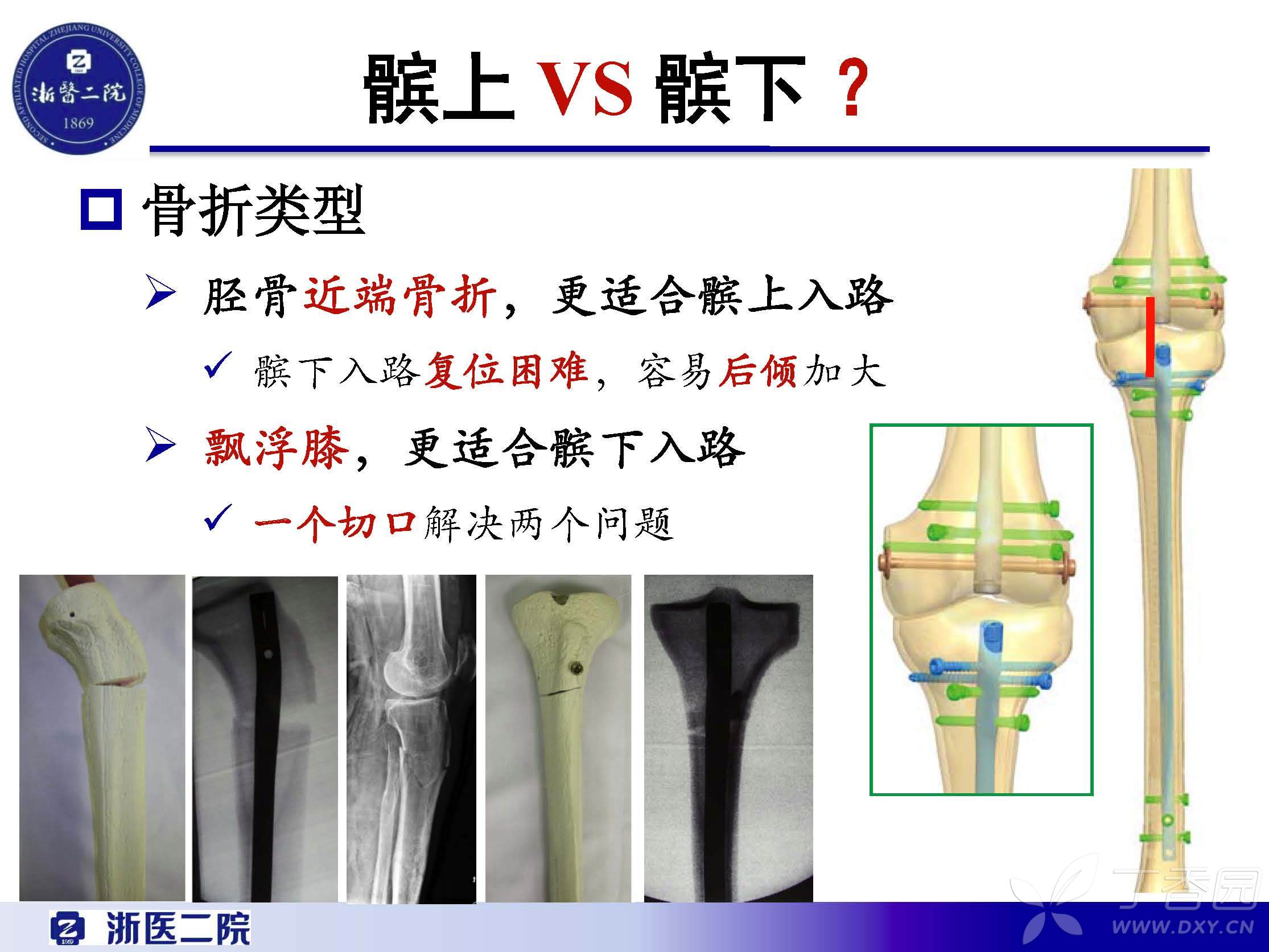 [精美ppt]-胫骨髓内钉:髌上入路 vs 髌下入路?