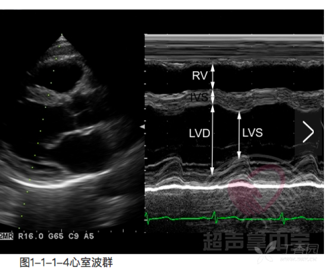 mv前叶前向运动,与ivs靠拢,m型超声心动图可见二尖瓣前叶活动曲线cd