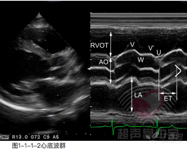 初始心超学习总结(一—胸骨旁左室长轴切面 超声医学讨论版