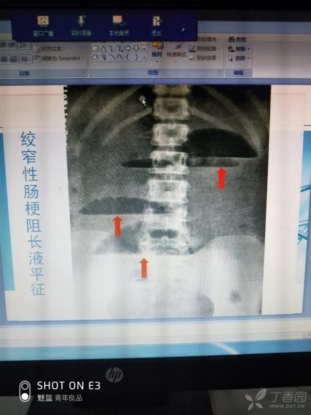 绞窄性肠梗阻x线报告