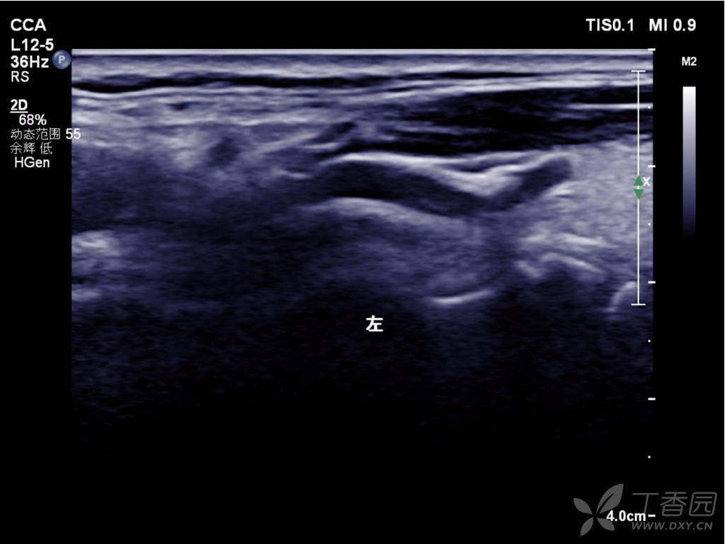 起源变异的甲状腺上动脉 - 超声医学讨论版 -丁香园