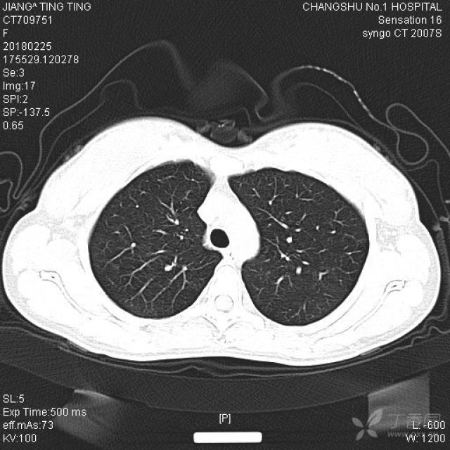 无症状,偶然发现右肺磨玻璃结节,前四张是2018-2-25拍的ct